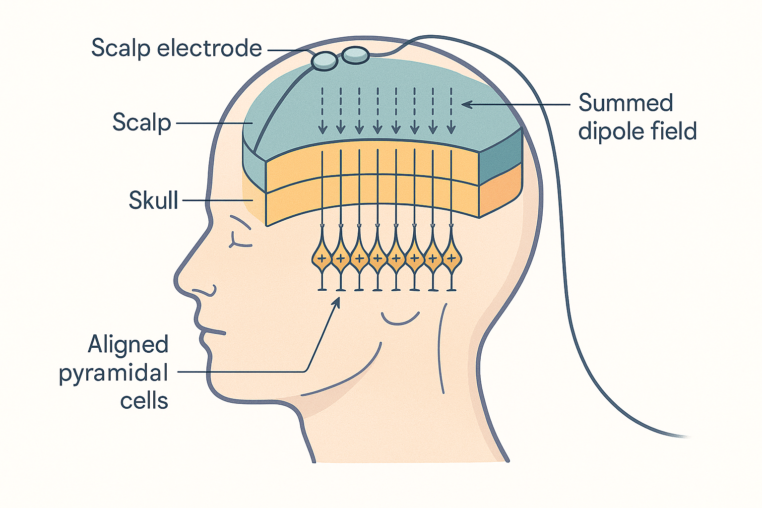 A side view of a human head wearing an EEG electrode cap, with a cutaway exposing the folded cortical surface beneath, showing rows of aligned pyramidal cells acting as parallel electrical dipoles whose summed field reaches a scalp electrode through skull and scalp layers